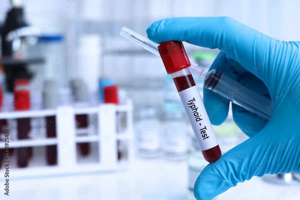 Checking Blood Tests for Typhoid
